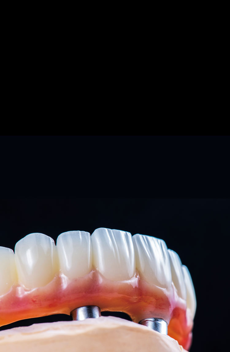 All-on-X dental restoration on black