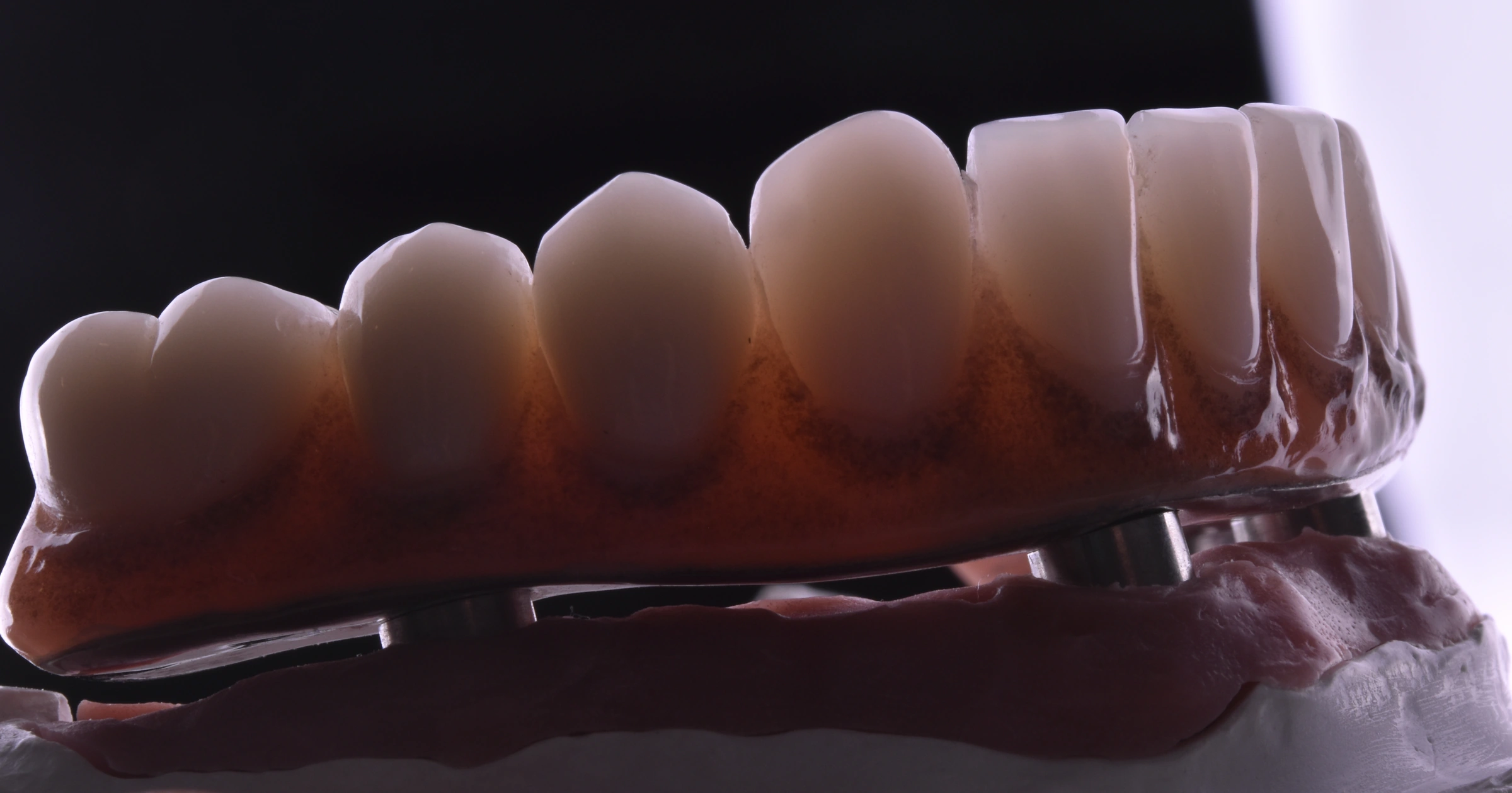 Close-up of a full-arch dental restoration on its model