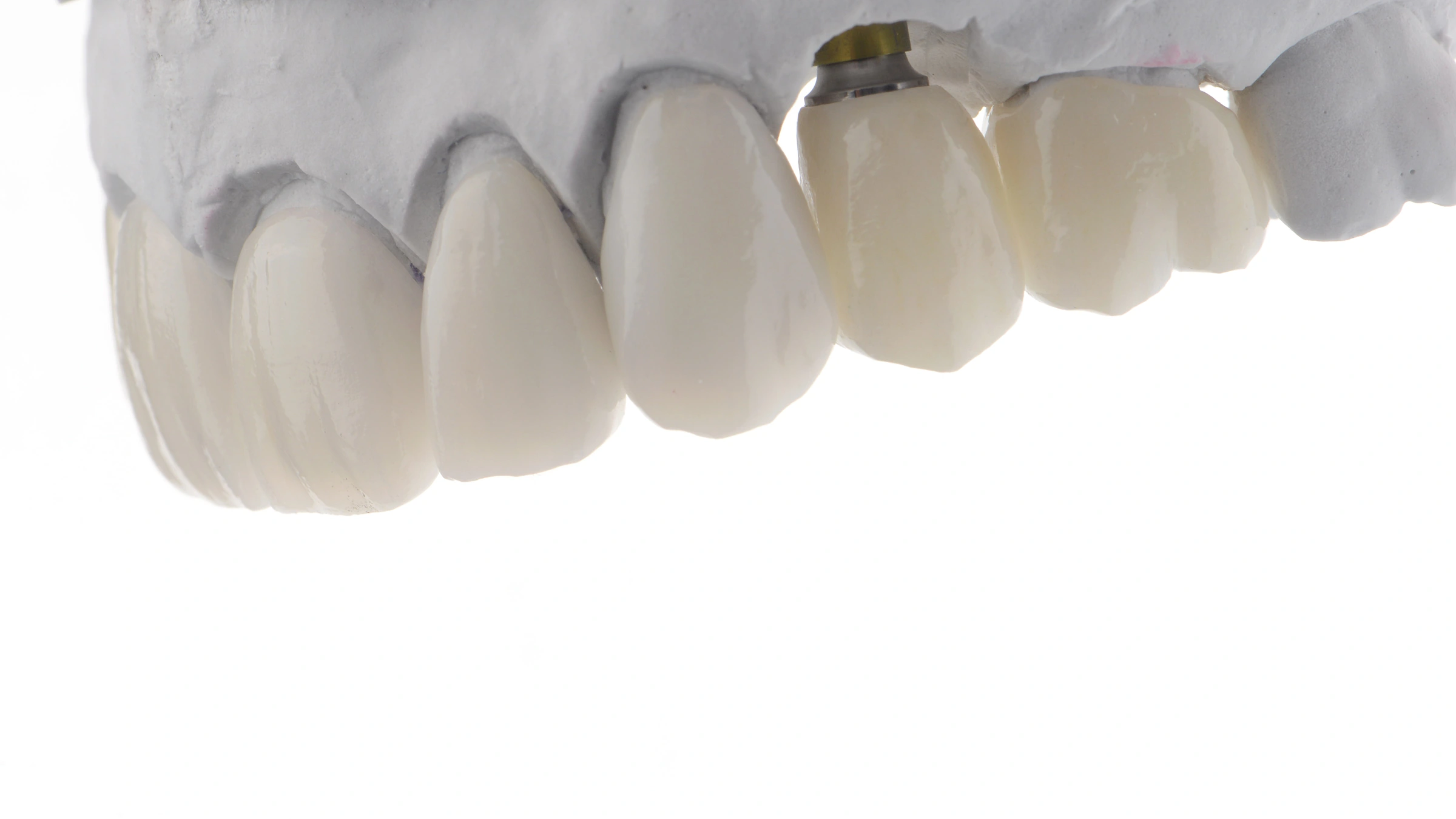 Close-up of ceramic dental restorations on a laboratory model