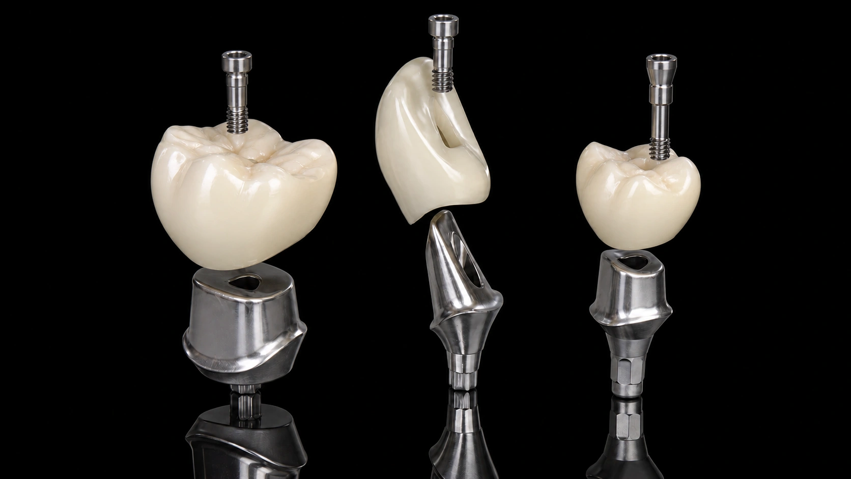 Custom abutments and screw-retained ceramic crowns