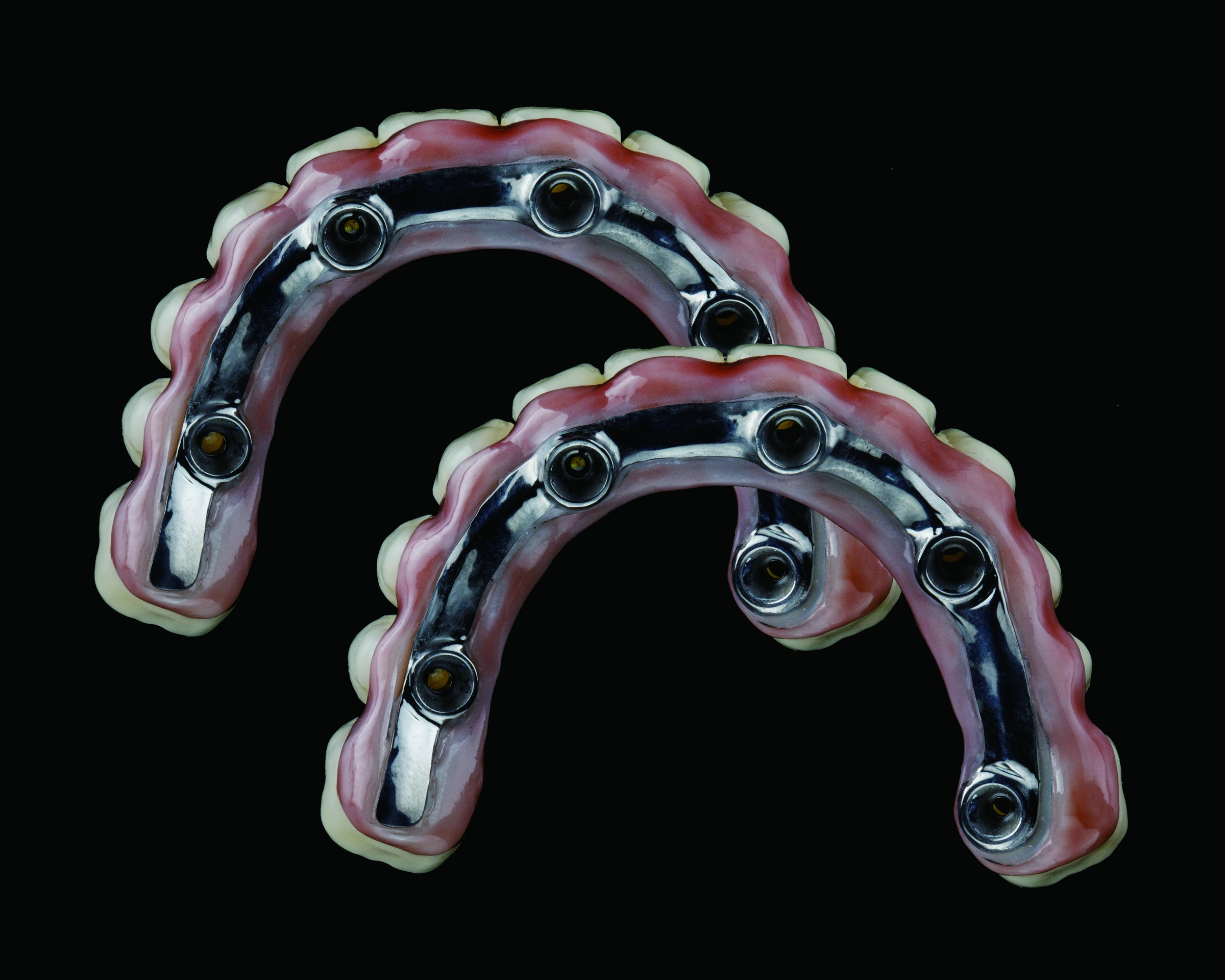 Titanium support bars on finished full-arch restorations