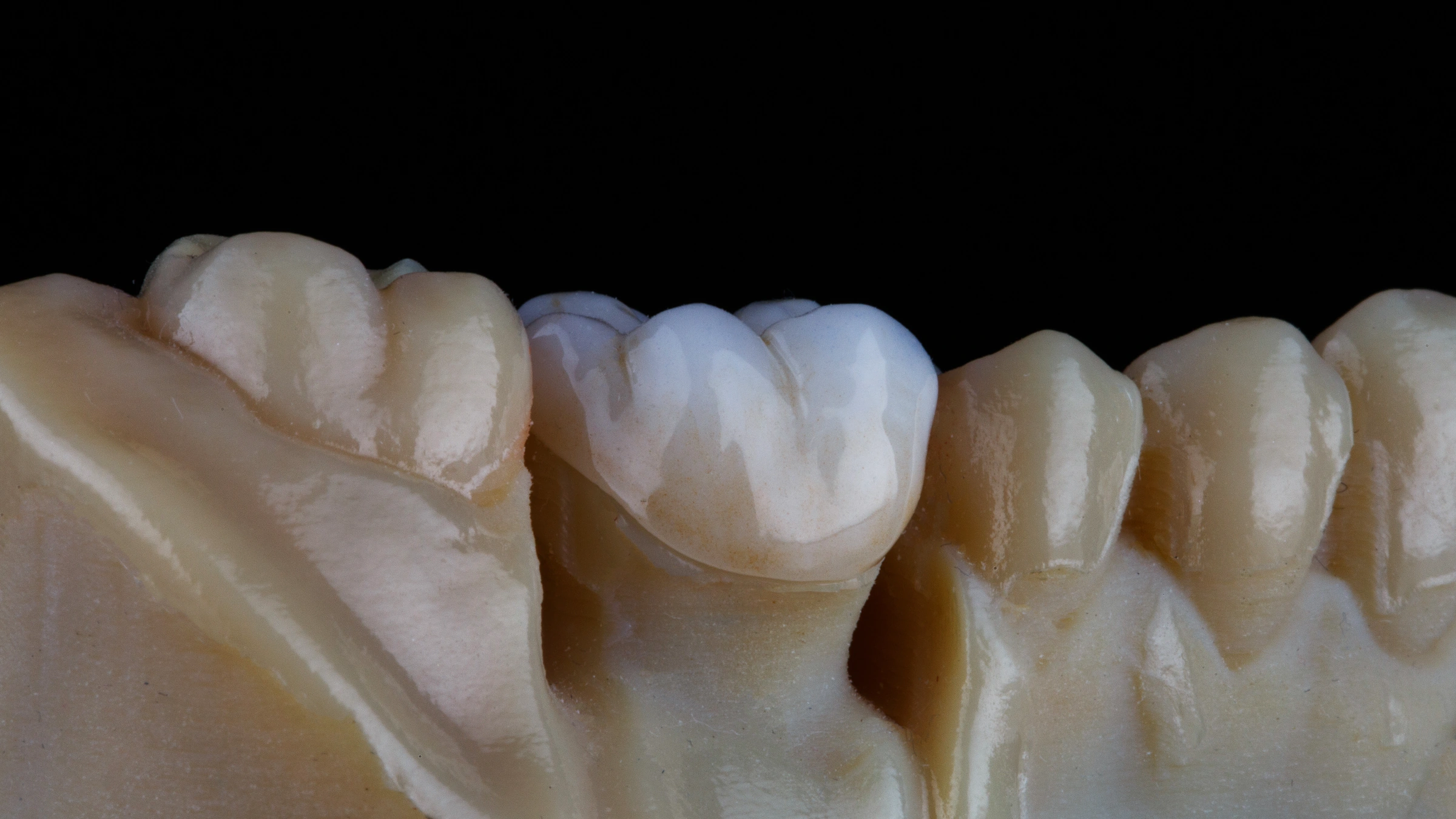 Close-up of a ceramic crown fitted on a dental model